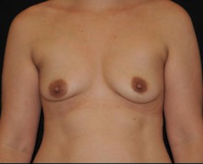 Breast Augmentation Before & After Gallery - Patient 437085 - Image 1