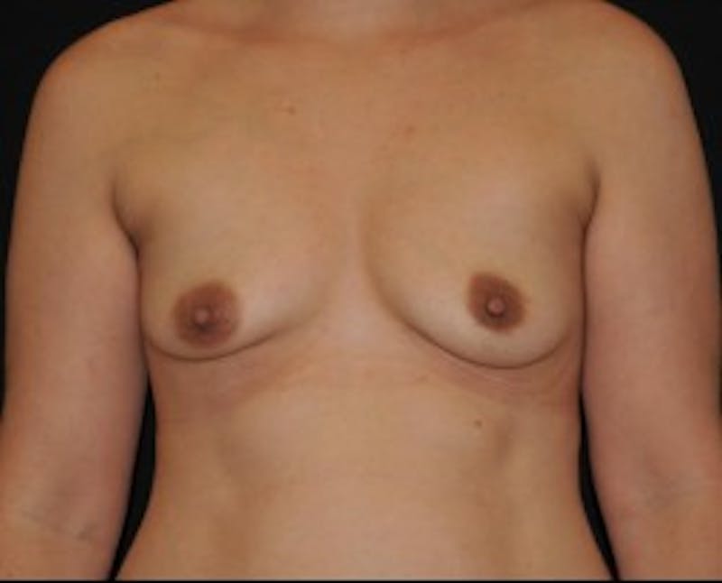 Breast Augmentation Before & After Gallery - Patient 437085 - Image 1