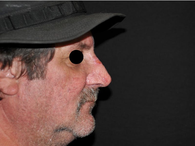 Rhinoplasty Before & After Gallery - Patient 873549 - Image 2