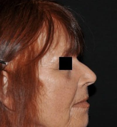 Rhinoplasty Before & After Gallery - Patient 675907 - Image 1