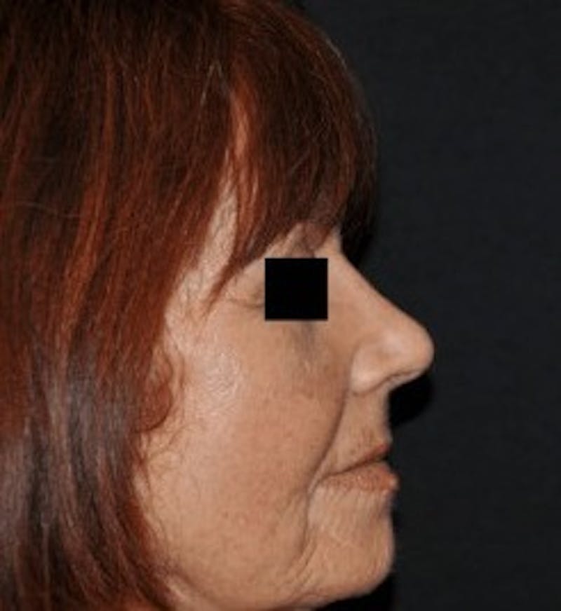 Rhinoplasty Before & After Gallery - Patient 675907 - Image 2