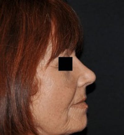 Rhinoplasty Before & After Gallery - Patient 675907 - Image 2