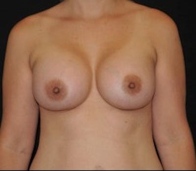 Breast Augmentation Before & After Gallery - Patient 437085 - Image 2