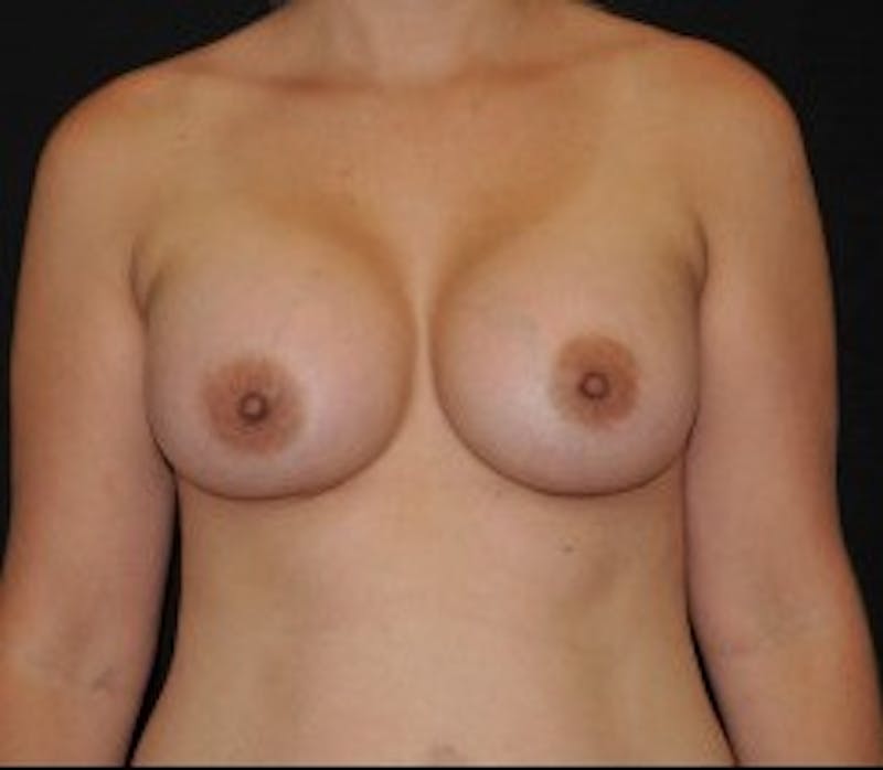 Breast Augmentation Before & After Gallery - Patient 437085 - Image 2