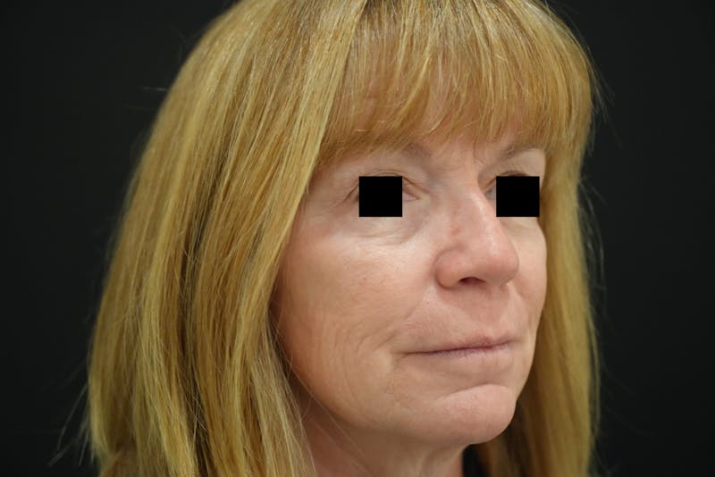 Ellacor Before & After Gallery - Patient 112412 - Image 1
