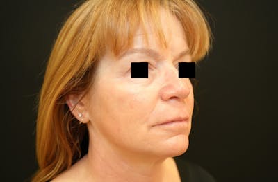 Ellacor Before & After Gallery - Patient 112412 - Image 2