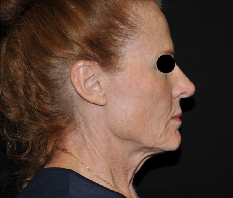 Chemical Peel Before & After Gallery - Patient 361132 - Image 1