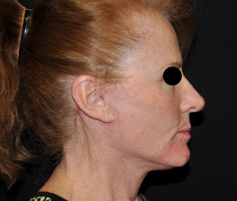 Chemical Peel Before & After Gallery - Patient 361132 - Image 2