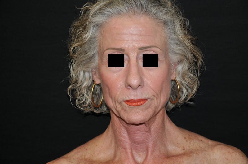 Chemical Peel Before & After Gallery - Patient 248857 - Image 1