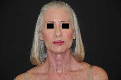Chemical Peel Before & After Gallery - Patient 248857 - Image 2