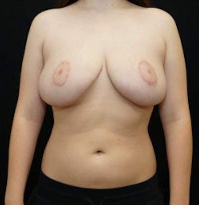 Breast Reduction Before & After Gallery - Patient 186487 - Image 2