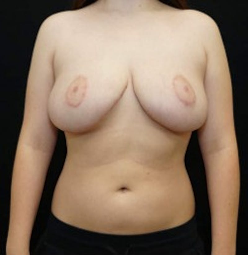 Breast Reduction Before & After Gallery - Patient 186487 - Image 2