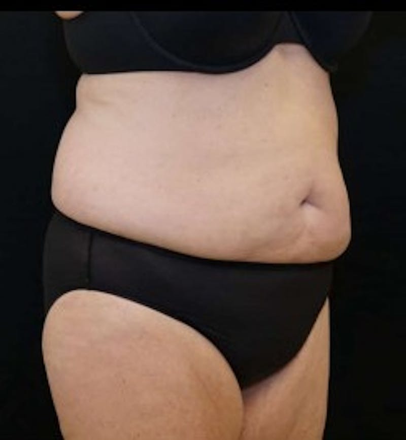 Liposuction Before & After Gallery - Patient 127074 - Image 1