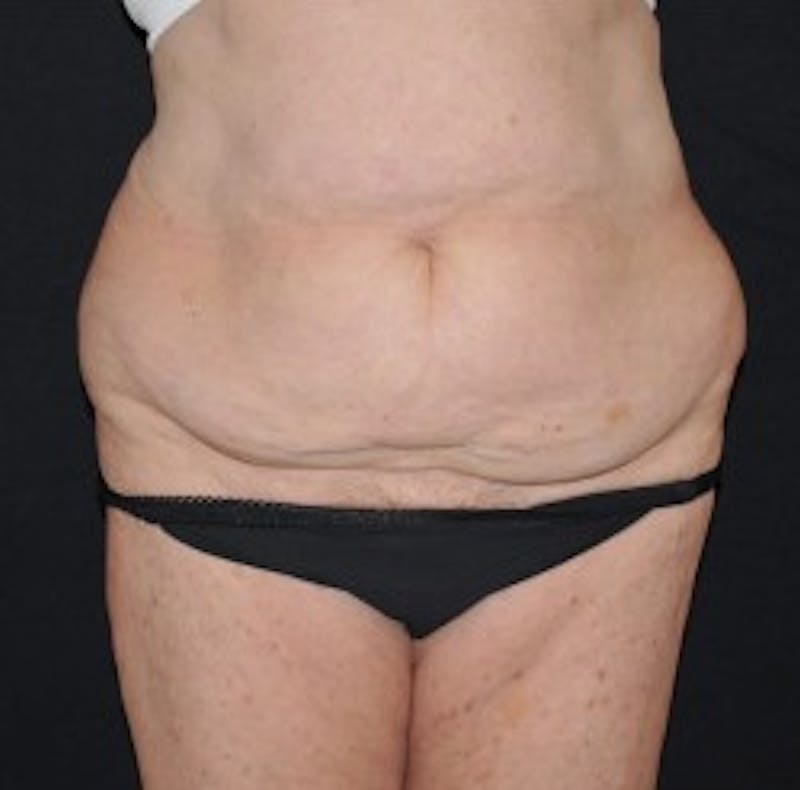 Liposuction Before & After Gallery - Patient 365305 - Image 1