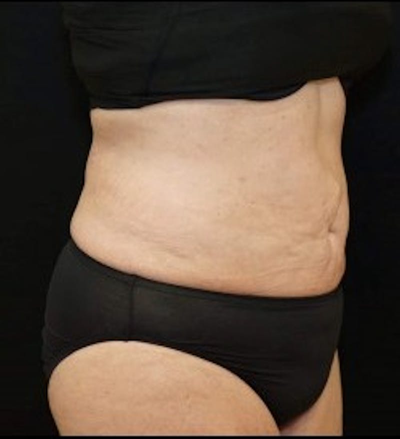 Liposuction Before & After Gallery - Patient 127074 - Image 2