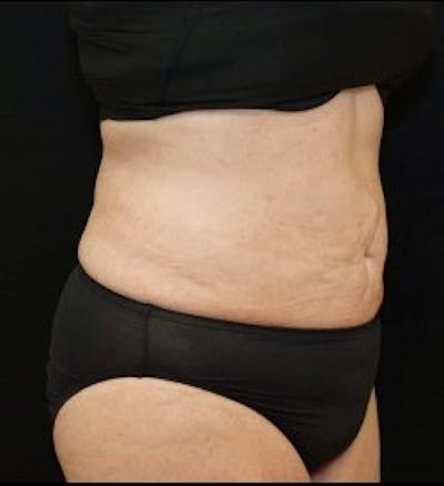 Liposuction Before & After Gallery - Patient 127074 - Image 2