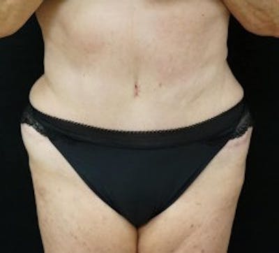 Liposuction Before & After Gallery - Patient 365305 - Image 2