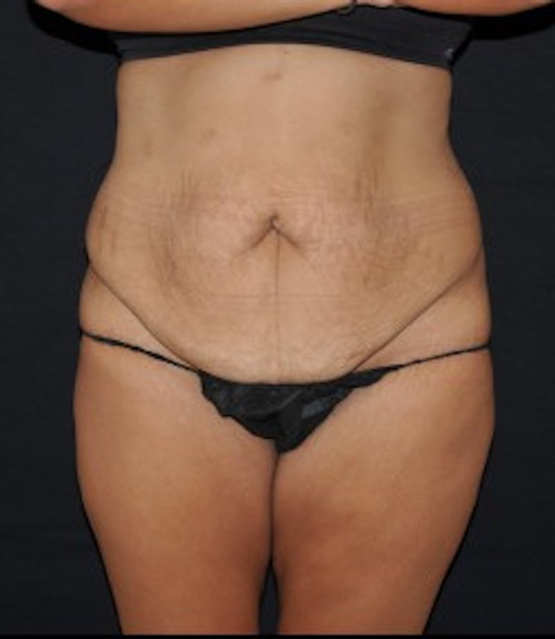 Liposuction Before & After Gallery - Patient 295583 - Image 1