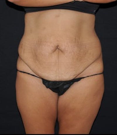 Liposuction Before & After Gallery - Patient 295583 - Image 1