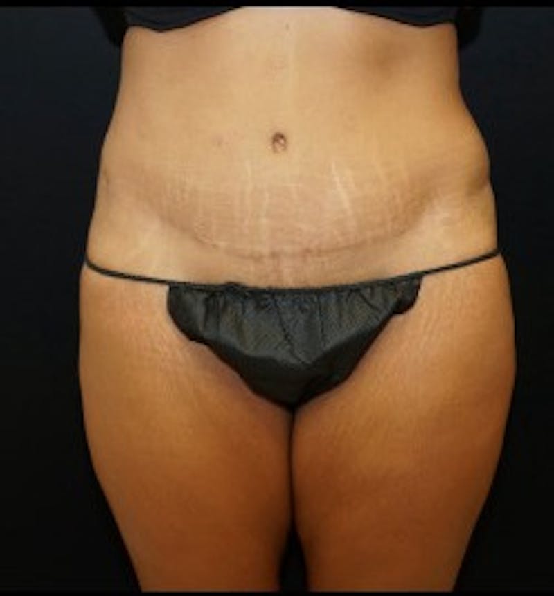 Liposuction Before & After Gallery - Patient 295583 - Image 2