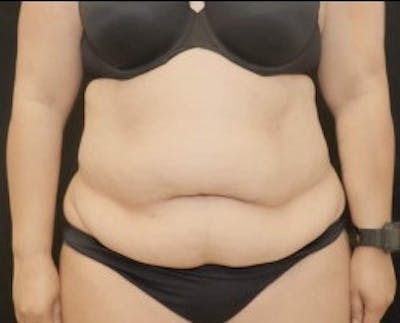 Liposuction Before & After Gallery - Patient 855033 - Image 1