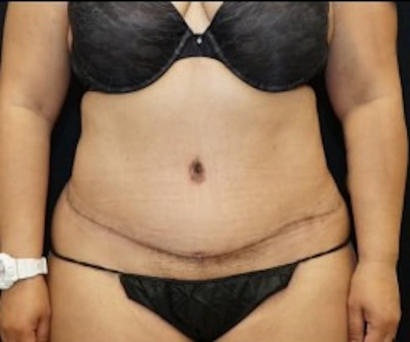 Liposuction Before & After Gallery - Patient 855033 - Image 2