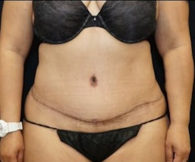 Liposuction Before & After Gallery - Patient 855033 - Image 2