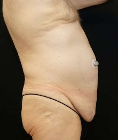 Liposuction Before & After Gallery - Patient 167291 - Image 1