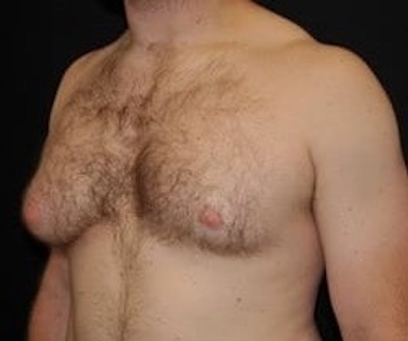 Gynecomastia Before & After Gallery - Patient 180419 - Image 1