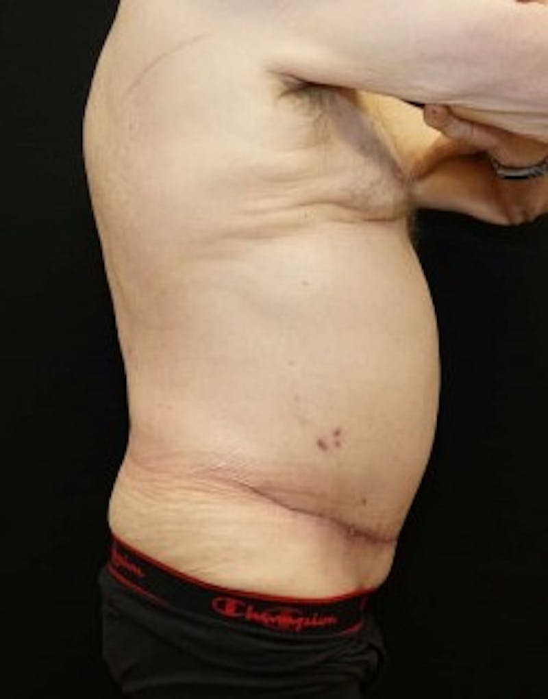 Tummy Tuck Before & After Gallery - Patient 266365 - Image 2
