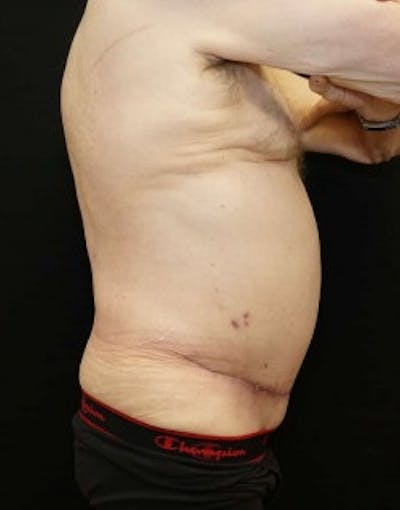 Liposuction Before & After Gallery - Patient 167291 - Image 2