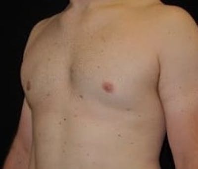 Gynecomastia Before & After Gallery - Patient 180419 - Image 2