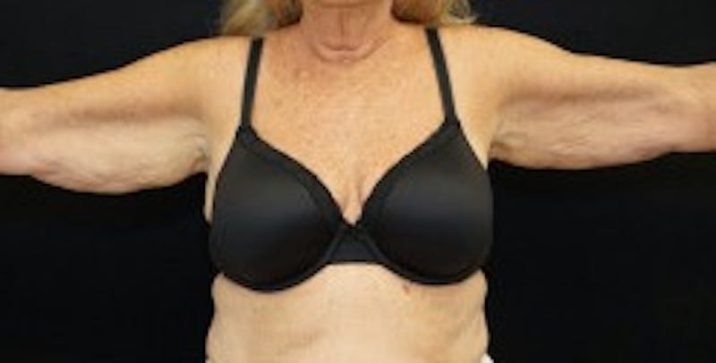 Arm Lift Before & After Gallery - Patient 170907 - Image 1