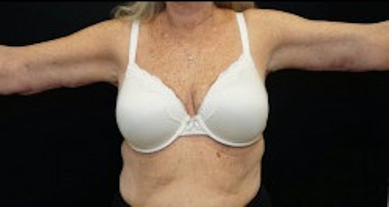 Arm Lift Before & After Gallery - Patient 170907 - Image 2