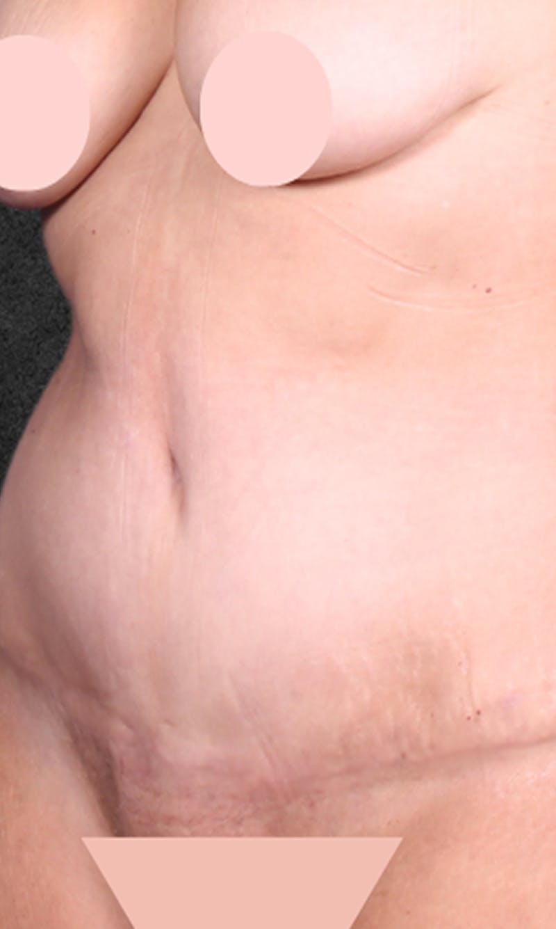 Tummy Tuck Before & After Gallery - Patient 729566 - Image 2