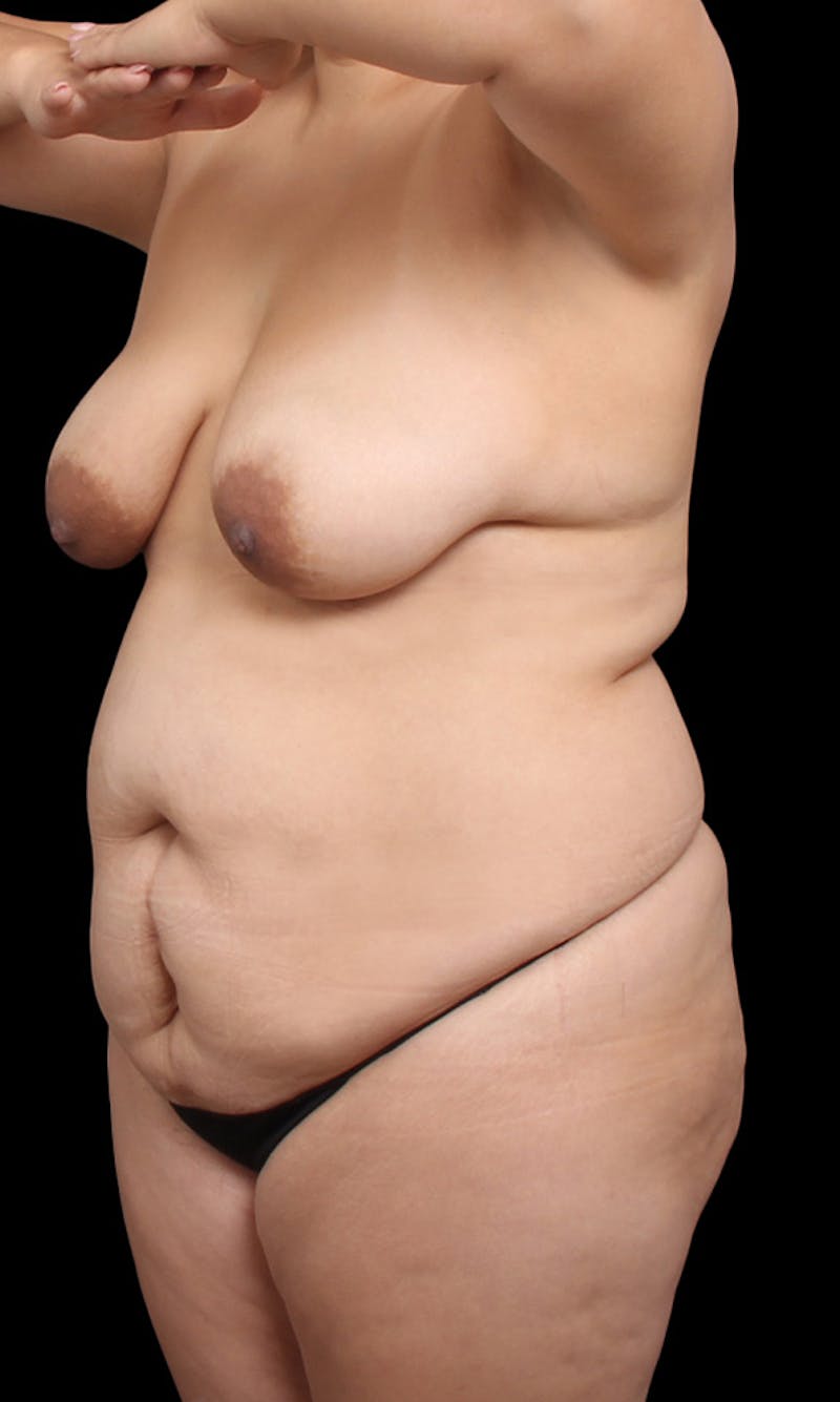 Tummy Tuck Before & After Gallery - Patient 416924 - Image 1
