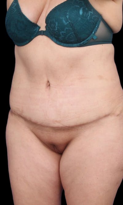 Tummy Tuck Before & After Gallery - Patient 186214 - Image 2