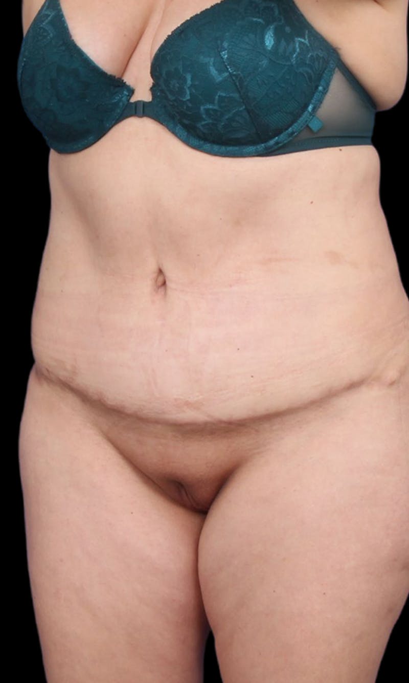 Tummy Tuck Before & After Gallery - Patient 186214 - Image 2