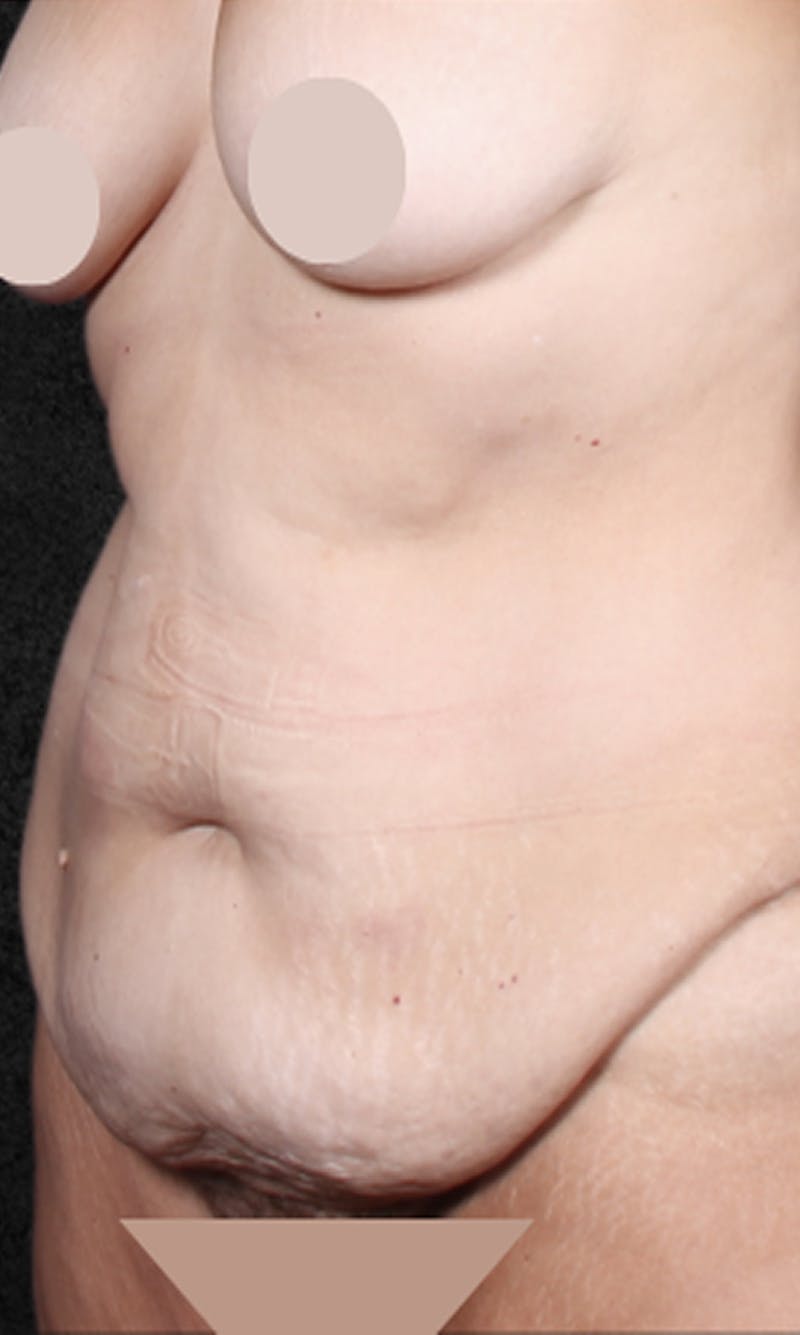 Tummy Tuck Before & After Gallery - Patient 729566 - Image 1