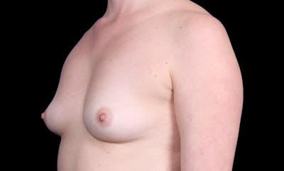 Breast Augmentation Before & After Gallery - Patient 873265 - Image 1