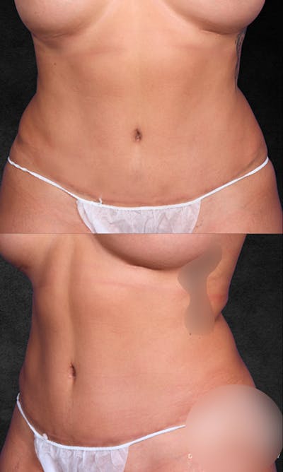 Tummy Tuck Before & After Gallery - Patient 369478 - Image 2