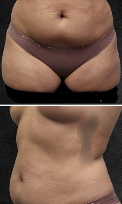 Tummy Tuck Before & After Gallery - Patient 369478 - Image 1