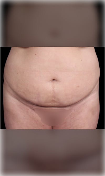 Tummy Tuck Before & After Gallery - Patient 386784 - Image 1