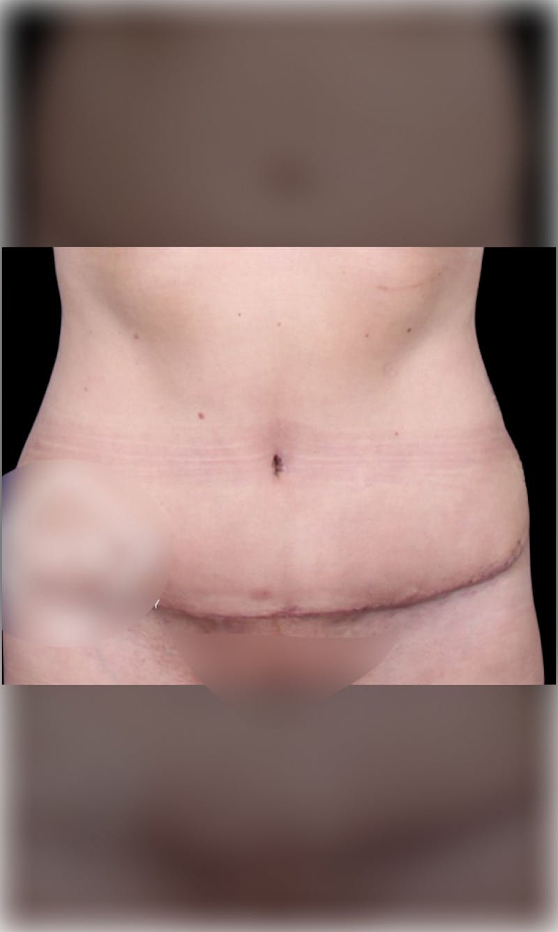 Tummy Tuck Before & After Gallery - Patient 386784 - Image 2