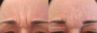11 Lines (Botox) Before & After Gallery - Patient 145014 - Image 1