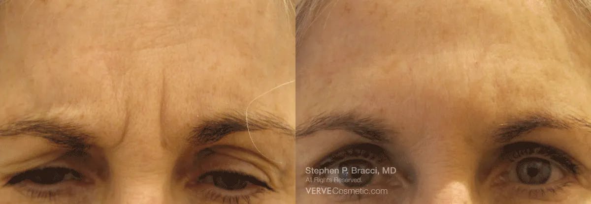 11 Lines (Botox) Before & After Gallery - Patient 287083 - Image 1