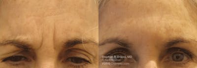 11 Lines (Botox) Before & After Gallery - Patient 287083 - Image 1