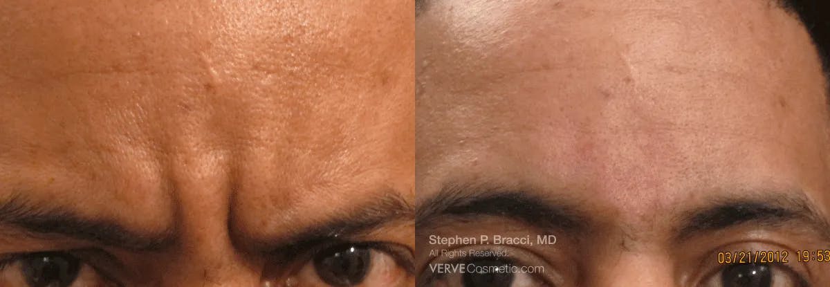 11 Lines (Botox) Before & After Gallery - Patient 363367 - Image 1