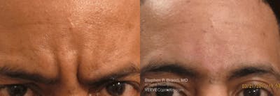 11 Lines (Botox) Before & After Gallery - Patient 363367 - Image 1