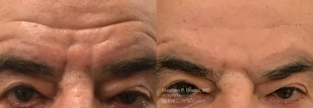 11 Lines (Botox) Before & After Gallery - Patient 340613 - Image 1